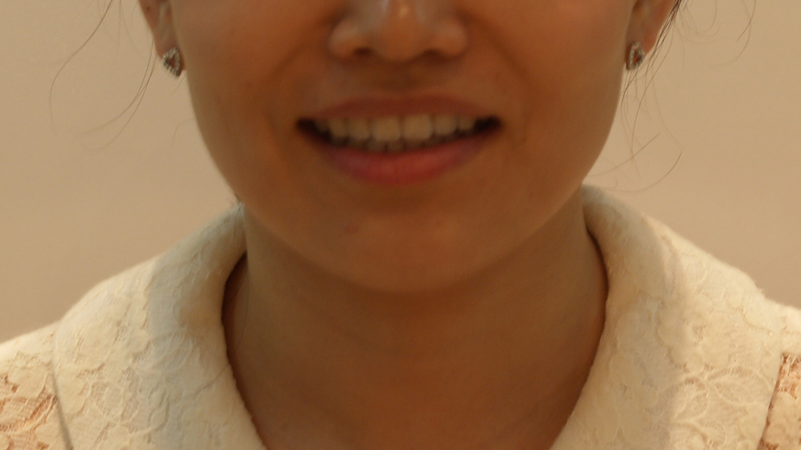 수술 후