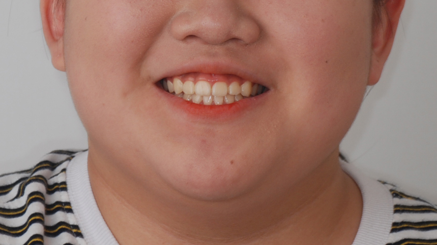 수술 후
