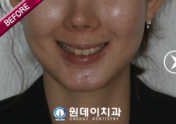 수술 전