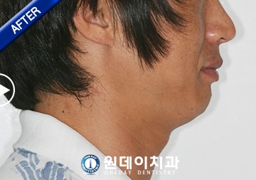 수술 후