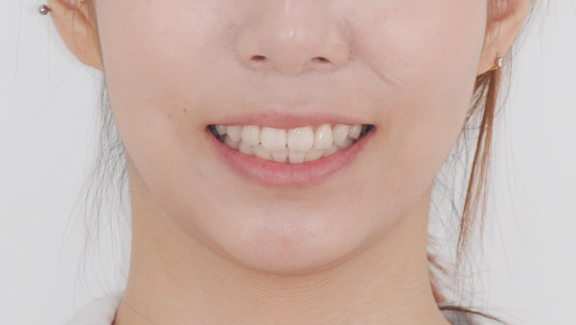 수술 후